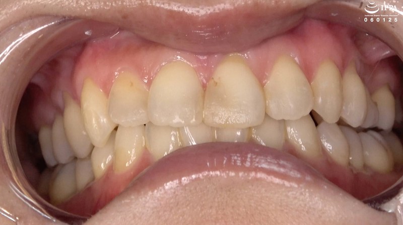 【歯・口内フェチ】「素人人妻マナミさんの超貴重な歯＆口内観察！」マナミh_1416ad01840